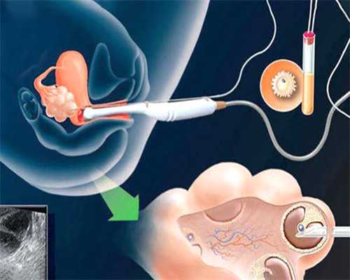 上海供卵代怀生男孩，私人做供卵试管