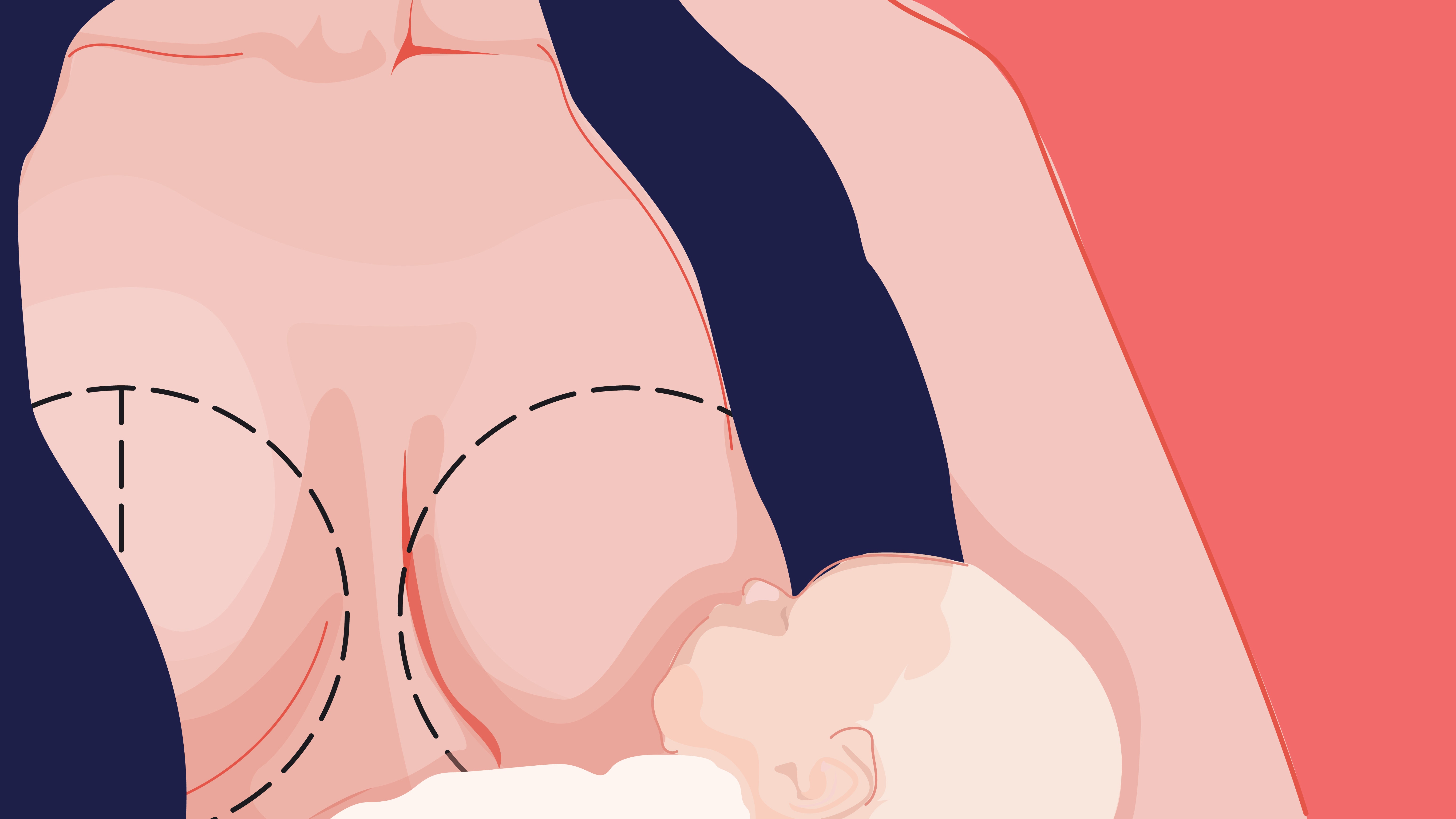 胎儿都成型了还是葡萄胎